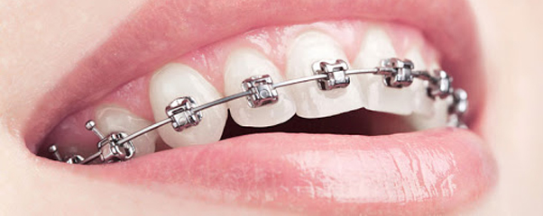 Что это ортодонтия?